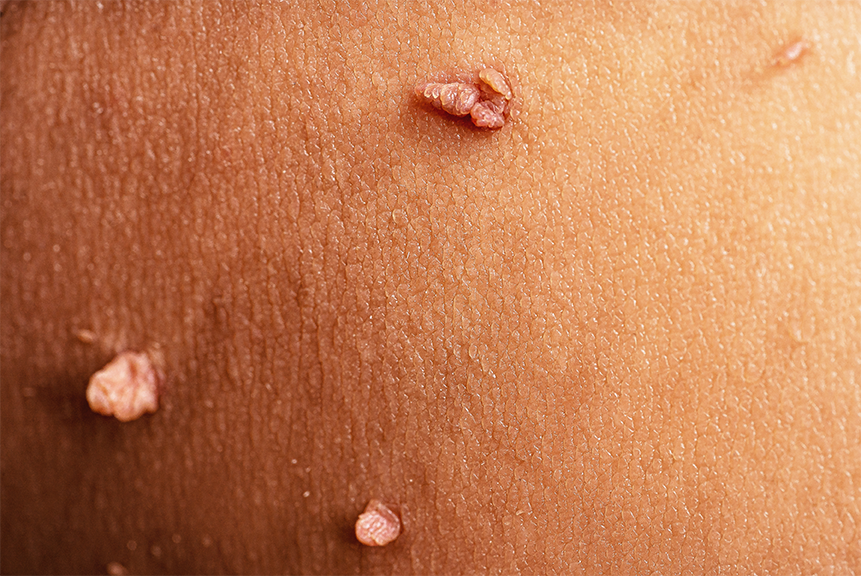 Skin tag removal by cauterization at Medicart Ottawa for smooth and even skin.
