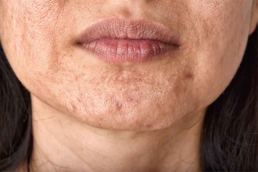 Microneedling in Ottawa: Reveal your skin's natural glow with our specialized treatments.
